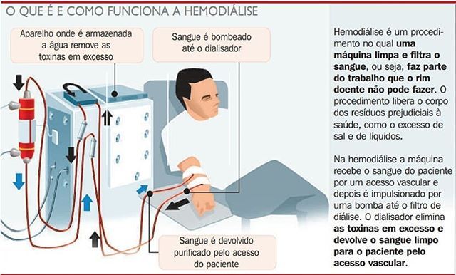 Hemodiálise é um procedimento no qual uma máquina limpa e filtra o sangue, ou seja, faz parte do trabalho que o rim doente não pode fazer. O procedimento libera o corpo dos resíduos prejudiciais à saúde, como o excesso de sal e de líquidos. 