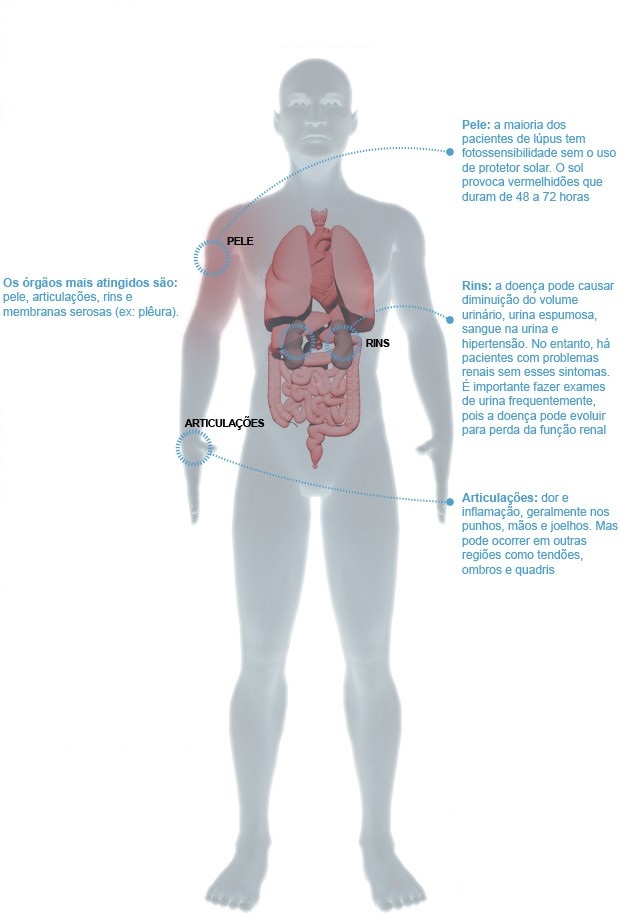 Lúpus Eritematoso Sistêmico (LES)