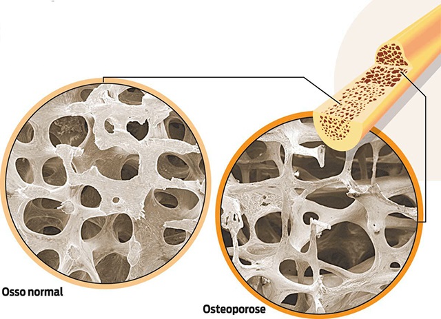 osteoporose o que e