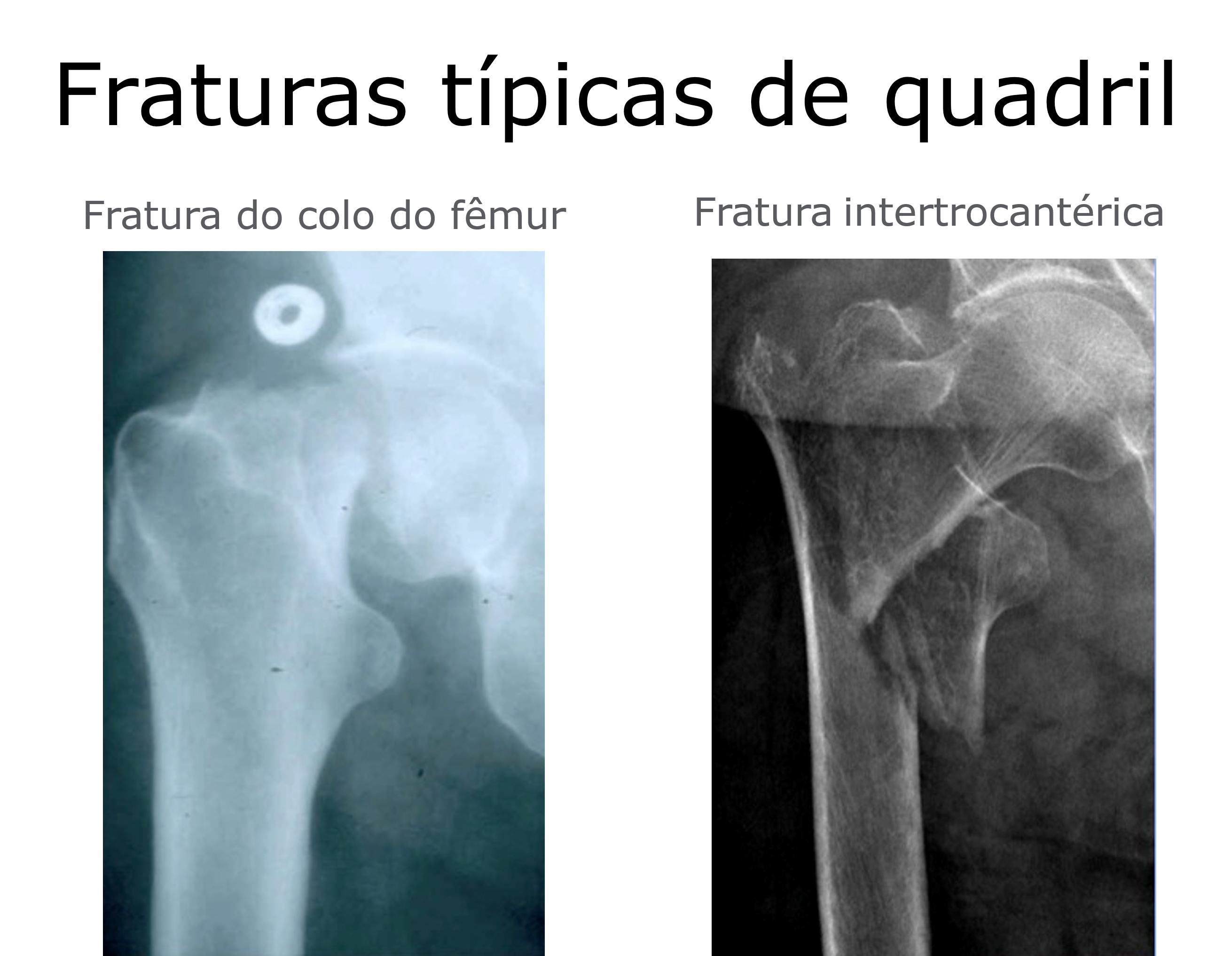 fratura de quadril 1 768x504