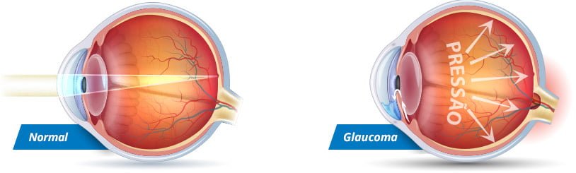 img oque glaucoma