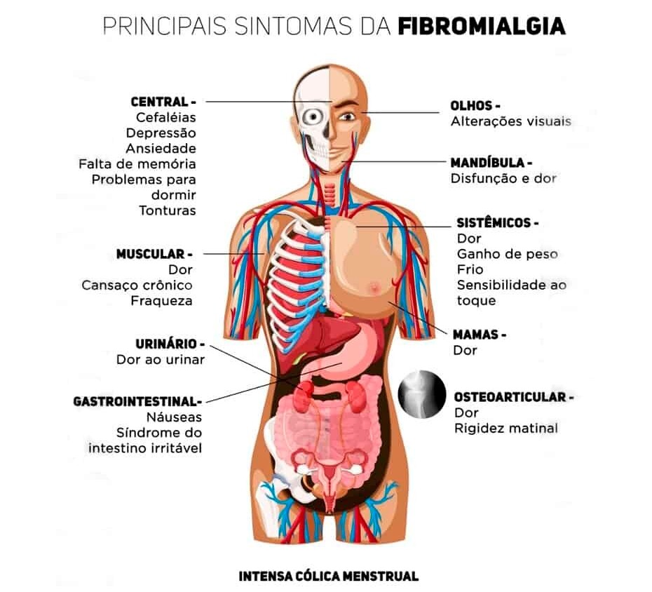 Sintomas da Fibromialgia