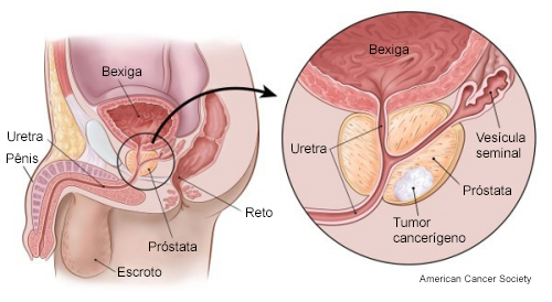 Prostata new