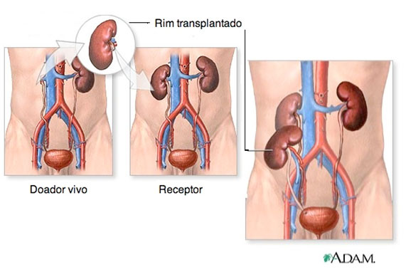 transplante renal