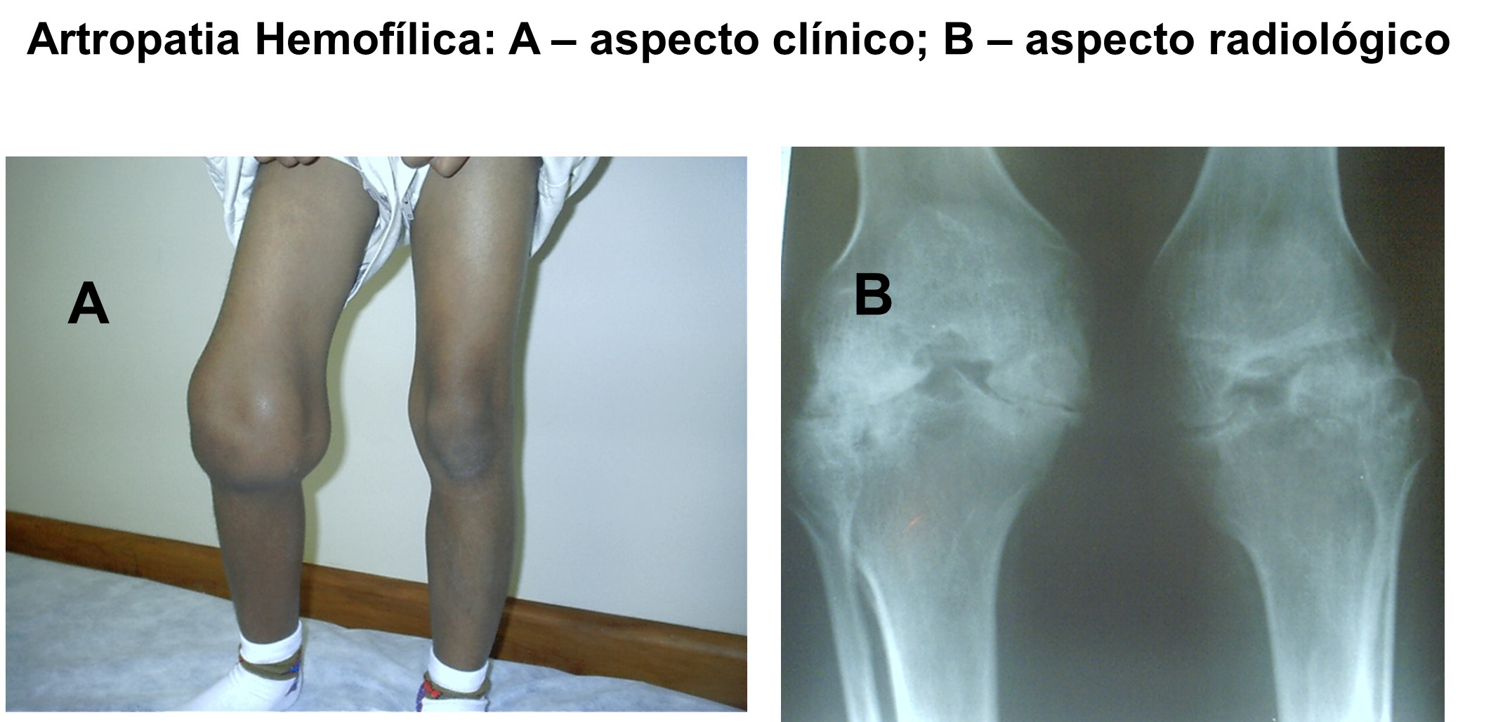 artropatia hemofílica