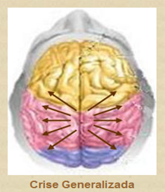 ataque epiléptico generalizado