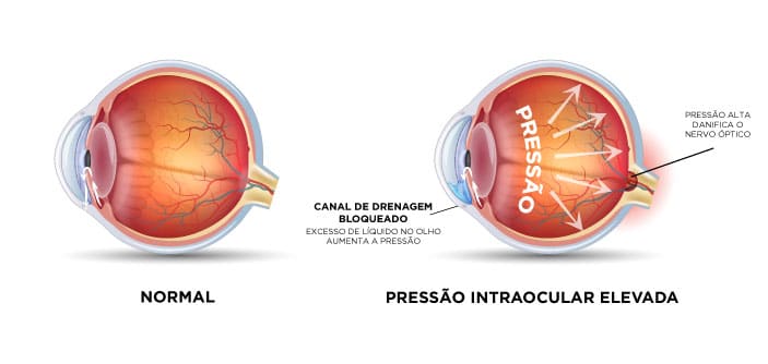 Pressão Intraocular