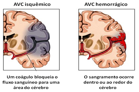 avc1 tipos