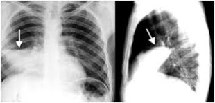 pneumonia RX