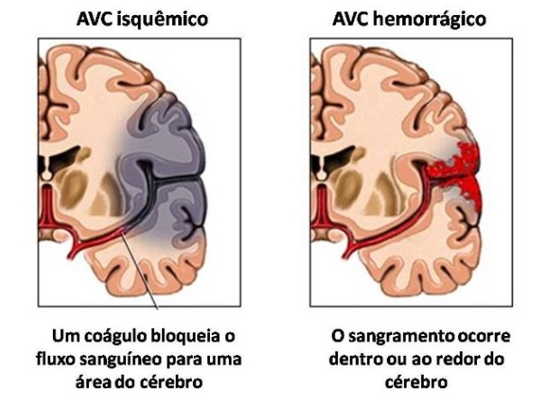 tipos de avc