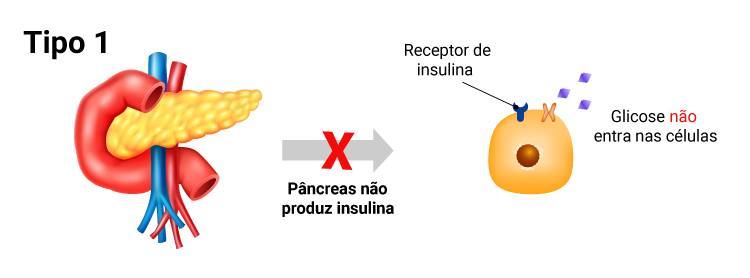 diabetes tipo1