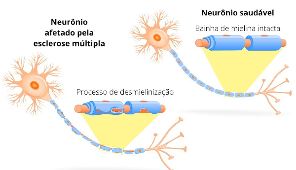 neuronio afetado pela esclerose multipla um saudavel