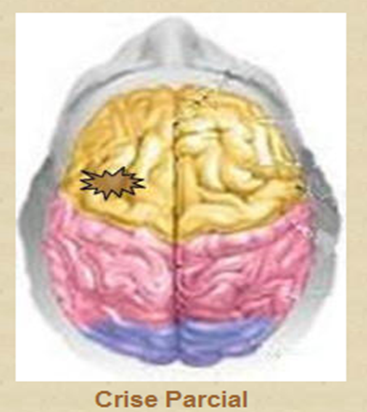 ataque epiléptico parcial