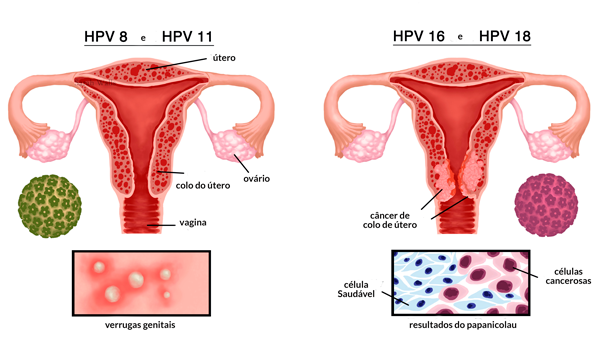 hpv marco lilas