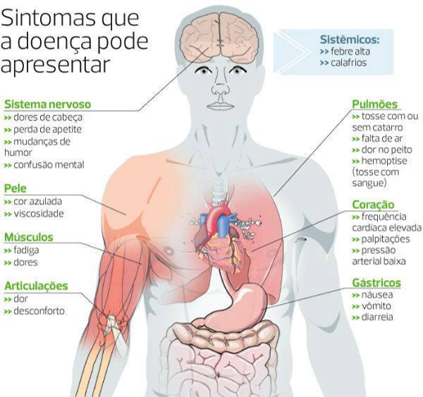 sintomas pneumonia