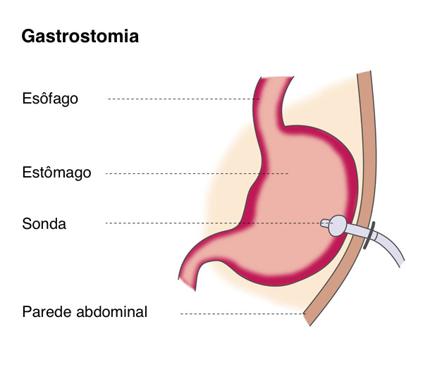 gastrostomia