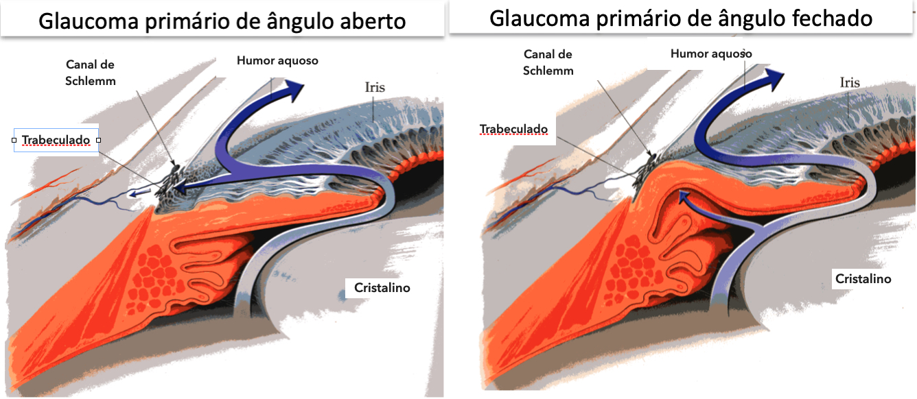 figuras glaucoma texto unifesp 2021