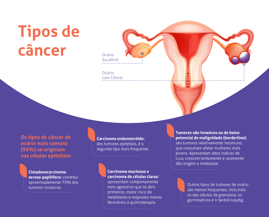 Tipos de Câncer - Os tipos de câncer de ovário mais comum nas células epiteliais: cistadenocarcinoma seroso-papilífero; carcinoma endometróide; carcinoma mucinoso e carcinoma de células claras; tumores não invasivos ou de baixo potencial de malignidade; e outros tipos de tumores de ovário são menos frequente, incluindo os das células da granulosa, os germinativos e o Sertoli-Leydig.