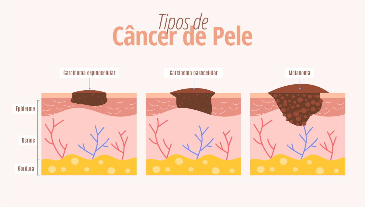 tipos de ca de pele