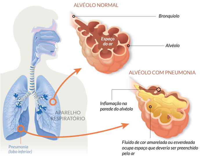 pneumonia