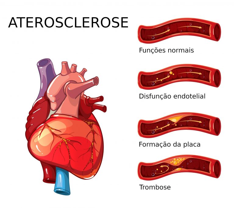 aterosclerose