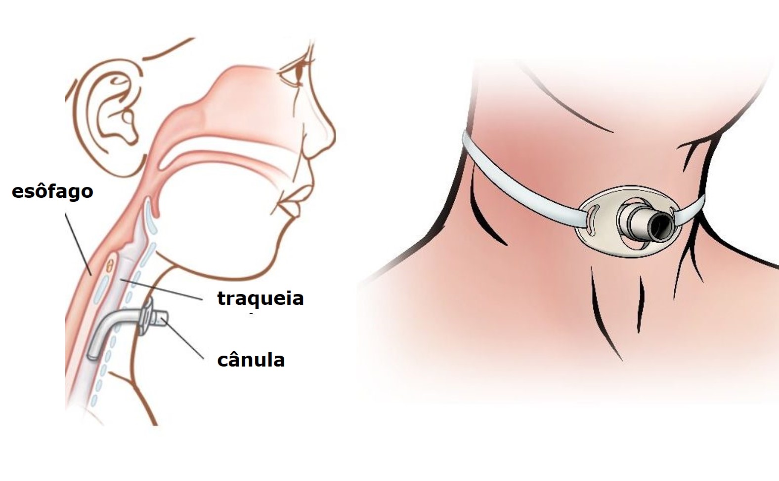 traqueostomia