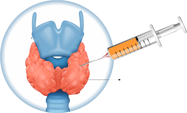 paaf tireoide